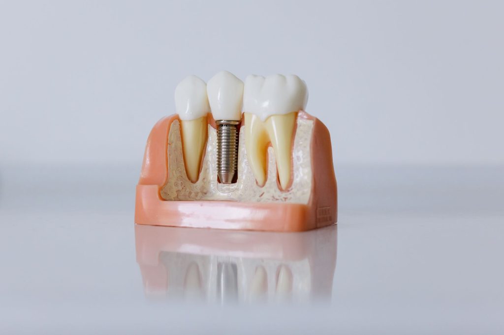 Full Mouth Dental Implants Turkey: Prices and Packages 2026
